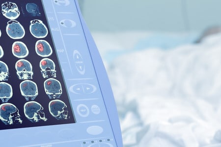 Failure to Perform Proper Work-Up of 2-Month-Old Leads to Severe Meningitis and Long Term Neurological Damages