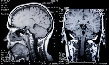 Undiagnosed Brain Aneurysm Ruptures, Results in Death