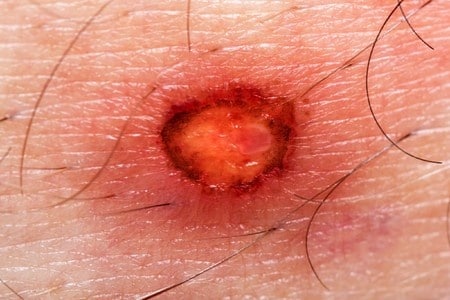 Da Vinci Surgical Device Severely Burns Patient