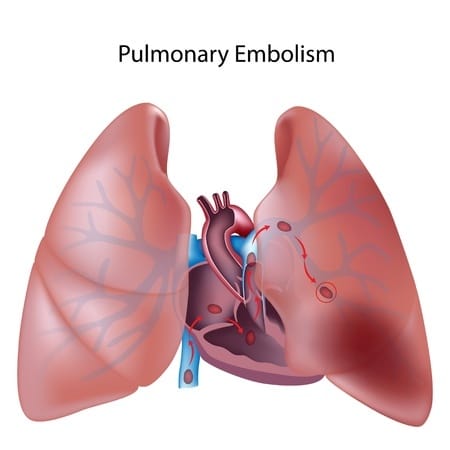 Failure to Diagnose Pulmonary Embolism Results in Patient’s Death