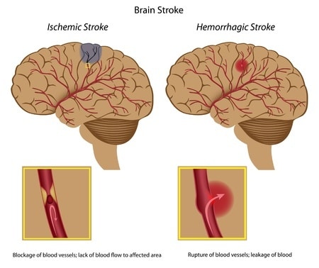 Delayed Stroke Diagnosis Results in Patient’s Death