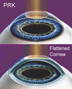 Ophthalmology Expert Witness Discusses Risks of LASIK and PRK Laser Eye Surgeries