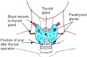 Otolaryngology Expert Witness Comments on Thyroidectomy Complications