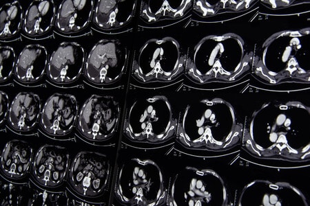 Delayed Diagnosis of Strangulated Bowel Leads to Bowel Resection