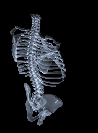 Orthopedic Surgeon Expert Witness Opines on Misplaced Pedicle Screw Removal