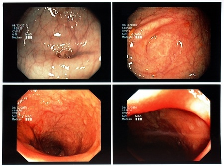 Fatal Colonoscopy Due to Bowel Perforation