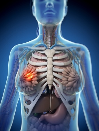 Oncology expert witness advises on relapse of breast cancer despite treatment