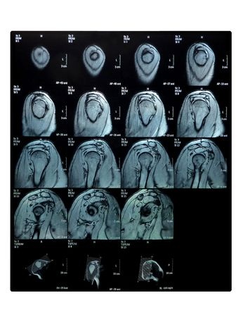 Orthopedic Expert Advises on Worker’s Alleged Injury Claim