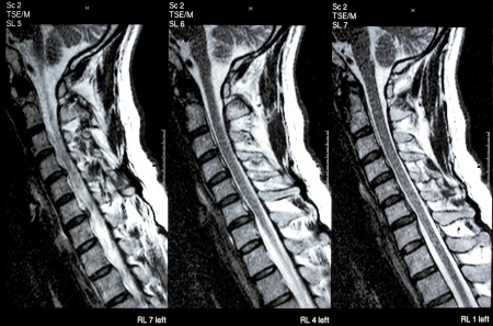 Neurology expert advises on disability benefits for nerve injury