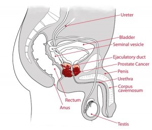Man Commits Suicide After Wrong Cancer Diagnosis, Urology Expert Opines