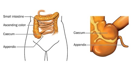Delayed Diagnosis of Appendicitis Results in Ruptured Appendix