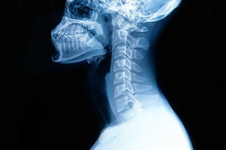 Undiagnosed Infection Leads to Paralysis