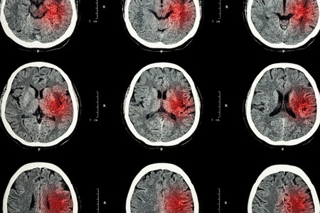 ER Doctors Fail to Diagnose Stroke