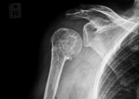 Doctors Fail to Follow Up With Patient Regarding Troubling Mammogram Results