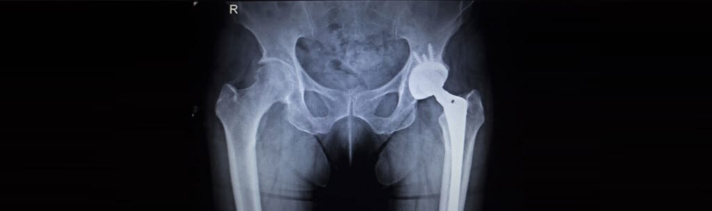 $502 Million Dollar Verdict Against Johnson & Johnson In DePuy Pinnacle Hip Implant MDL