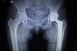 Hip Implant Expert Witness
