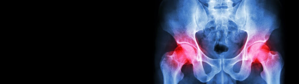 Expert Perspectives – Understanding Medical Malpractice With Total Hip Replacements