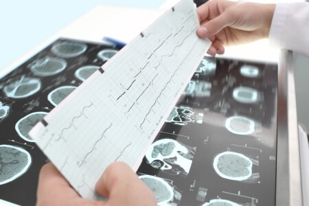Neuroradiology Experts Opine on Unexpected Hemorrhage
