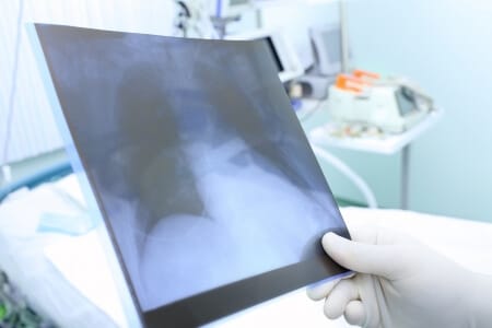 LVAD Heart Monitor Manufacturer Sued for Causing Severe Abscess