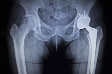 FDA Regulation Expert Opines on Zimmer Hip Replacement Metallosis