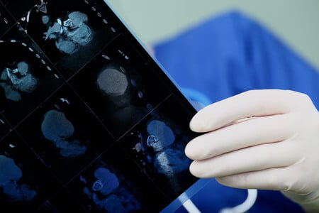 Man is Killed by Undetected Hernia Following Gastric Bypass Surgery