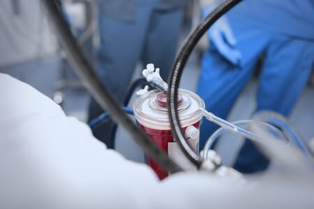 Patient Develops Compartment Syndrome Following Heart Valve Replacement