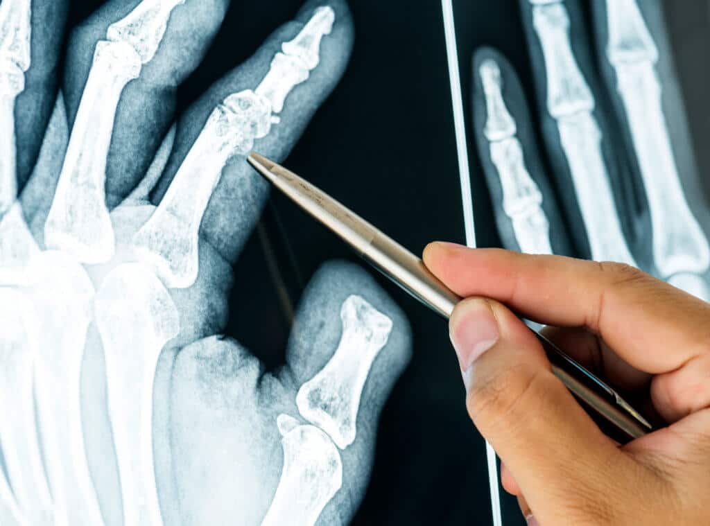 Nephrology Experts May Opine on Plaintiff’s General Condition as it Coexists with Diabetes, Osteoporosis